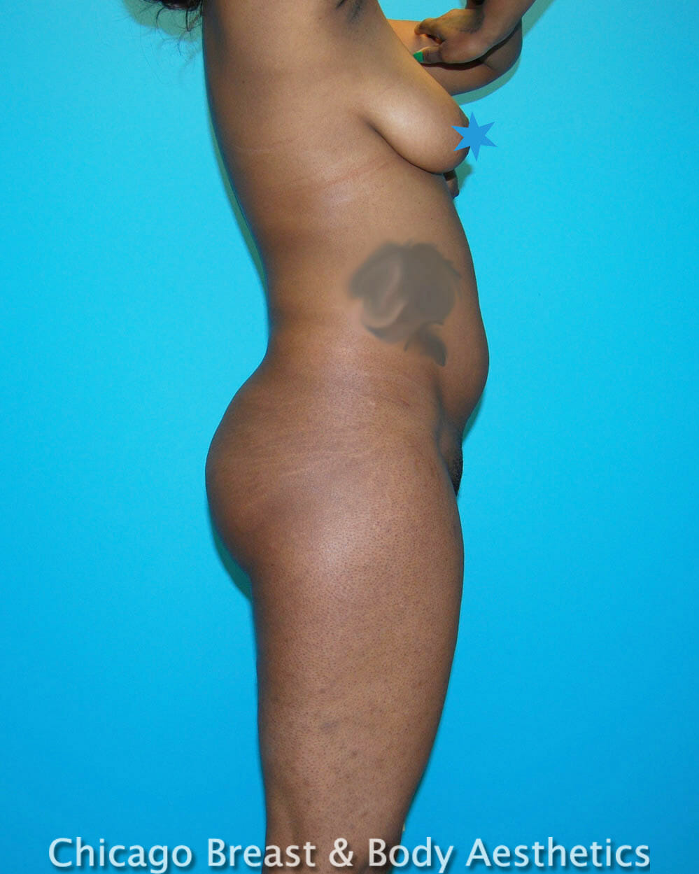 Lipo 360, 523