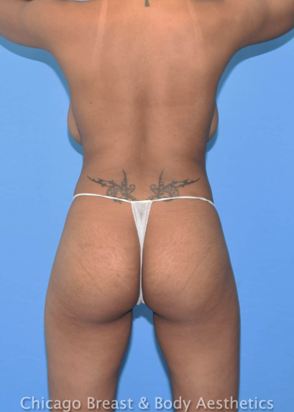 Brazilian Butt Lift, Case# 35348