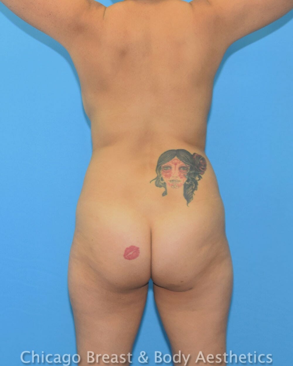 Brazilian Butt Lift Case# 31483