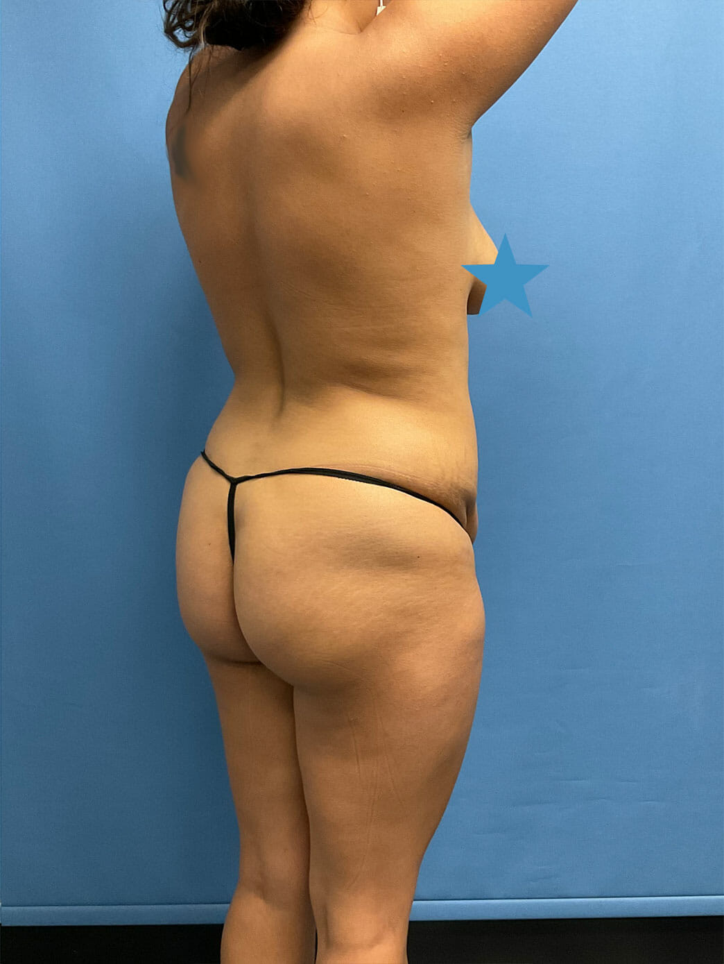 Brazilian Butt Lift, Brazilian Butt Lift Case# 1751