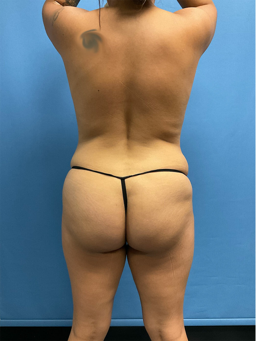 Brazilian Butt Lift, Brazilian Butt Lift Case# 1751