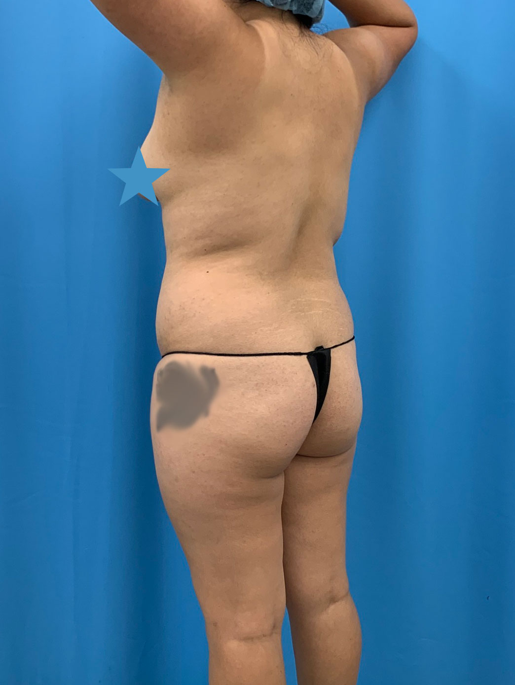 Brazilian Butt Lift, Case# 1213