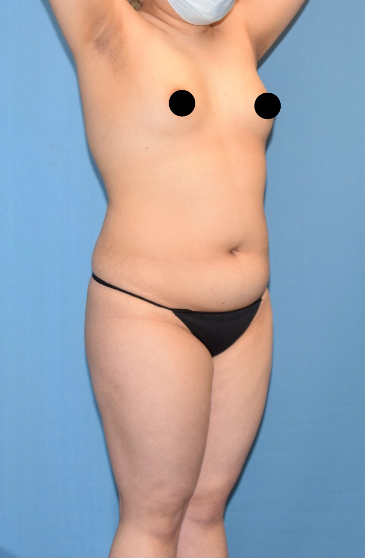Lipo 360, Case# 2013