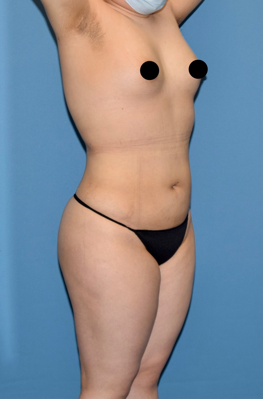 Lipo 360, Case# 2013