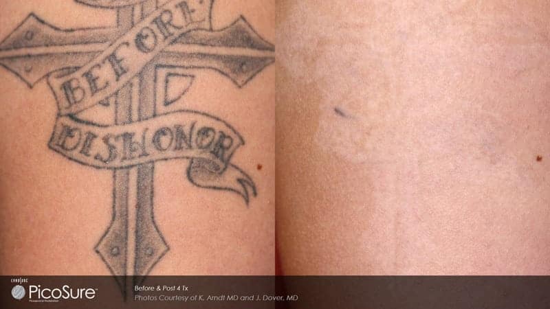 before and after laser tattoo removal