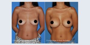 breastaugmentation