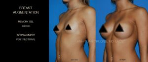 Breast-Augmentation